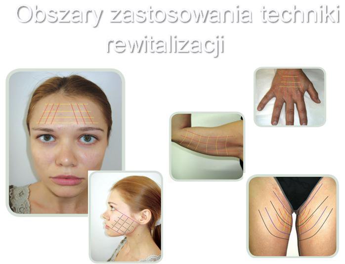 nici liftingujące Obszary zastosowania