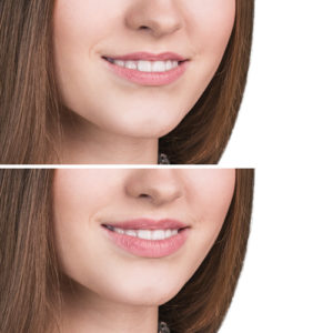 Efekt - powiększanie ust Warszawa Bellisana